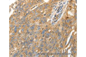 Immunohistochemistry of Human ovarian cancer using CALR Polyclonal Antibody at dilution of 1:50 (Calreticulin anticorps)