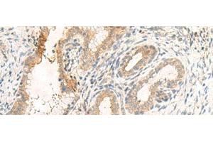 Immunohistochemistry of paraffin-embedded Human cervical cancer tissue using GPR89A/GPR89B Polyclonal Antibody at dilution of 1:25(x200) (GPR89A anticorps)