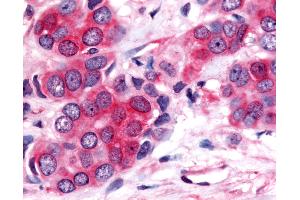 Anti-Nor-1 / NR4A3 antibody IHC of human Breast, Carcinoma.