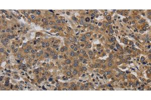 Immunohistochemistry of paraffin-embedded Human liver cancer tissue using KIF4A Polyclonal Antibody at dilution 1:40 (KIF4A anticorps)
