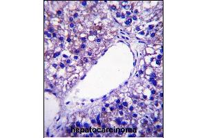 PNPLA4 Antibody (C-term) (ABIN657892 and ABIN2846844) immunohistochemistry analysis in formalin fixed and paraffin embedded human hepatocarcinoma followed by peroxidase conjugation of the secondary antibody and DAB staining.