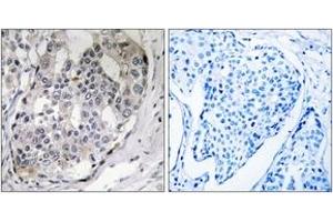Immunohistochemistry analysis of paraffin-embedded human breast carcinoma, using DARPP-32 (Phospho-Thr75) Antibody. (DARPP32 anticorps  (pThr75))