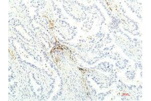Immunohistochemical analysis of paraffin-embedded Human Lung Carcinoma Tissue using JAK1 Mouse mAb diluted at 1:200. (JAK1 anticorps  (AA 960-1040))