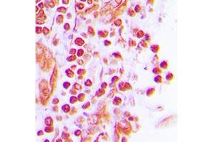 Immunohistochemical analysis of JUNB staining in human breast cancer formalin fixed paraffin embedded tissue section.
