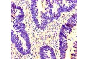 Immunohistochemistry of paraffin-embedded human ovarian cancer using ABIN7142095 at dilution of 1:100 (14-3-3 gamma anticorps  (AA 113-194))