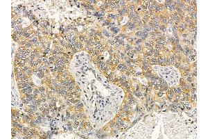 Cytokeratin 17 Mouse Monoclonal Antibody at 1/100 staining human lung cancer and adjacent non-tumor tissue by IHC-P. (KRT17 anticorps  (Internal Region))