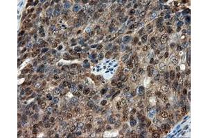 Immunohistochemical staining of paraffin-embedded Adenocarcinoma of colon tissue using anti-CUGBP1 mouse monoclonal antibody.
