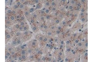 Detection of CD301 in Human Liver cancer Tissue using Polyclonal Antibody to Cluster Of differentiation 301 (CD301)