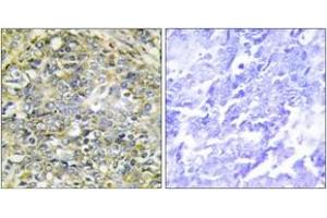 Immunohistochemistry analysis of paraffin-embedded human lung carcinoma tissue, using UBXD5 Antibody.