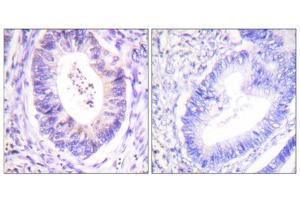 Immunohistochemistry analysis of paraffin-embedded human colon carcinoma tissue using p90 RSK (epitope around residue 573) antibody.