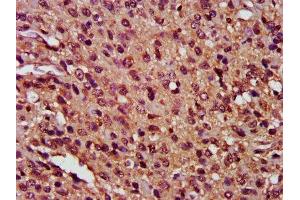 IHC image of ABIN7146901 diluted at 1:400 and staining in paraffin-embedded human glioma performed on a Leica BondTM system.
