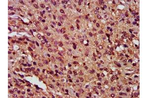 IHC image of ABIN7146901 diluted at 1:400 and staining in paraffin-embedded human glioma performed on a Leica BondTM system. (FLIP anticorps  (AA 1-250))