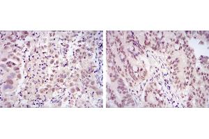 Immunohistochemical analysis of paraffin-embedded endometrial cancer tissues (left) and rectum cancer tissues (right) using CDK9 mouse mAb with DAB staining. (CDK9 anticorps)