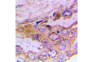 Immunohistochemical analysis of CaMK1 alpha (pT177) staining in human lung cancer formalin fixed paraffin embedded tissue section. (CAMK1 anticorps  (pSer177))