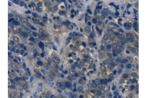 IHC-P analysis of Human Thyroid cancer Tissue, with DAB staining. (Tyrosine Hydroxylase anticorps  (AA 82-310))