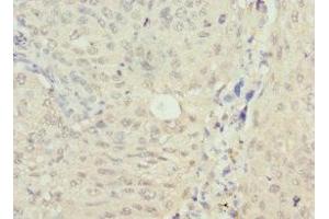 Immunohistochemistry of paraffin-embedded human lung cancer using ABIN7161740 at dilution of 1:100 (NSFL1C anticorps  (AA 1-185))