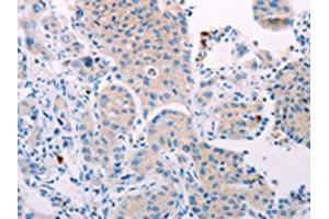 The image on the left is immunohistochemistry of paraffin-embedded Human lung cancer tissue using ABIN7131321(TEKT4 Antibody) at dilution 1/10, on the right is treated with fusion protein. (Tektin 4 anticorps)