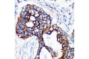 Immunohistochemistry of paraffin-embedded Human colon carcinoma using [KO Validated] CHCHD2 Rabbit pAb (ABIN7266448) at dilution of 1:100 (40x lens). (CHCHD2 anticorps  (AA 75-145))