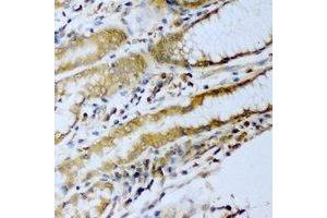 Immunohistochemical analysis of ERG staining in human stomach cancer formalin fixed paraffin embedded tissue section. (ERG anticorps)