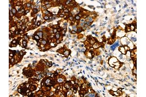 Phospho-MAP3K8/COT (Ser443) Antibody at 1/100 staining Human ovarian cancer by IHC-P.