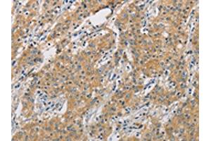The image on the left is immunohistochemistry of paraffin-embedded Human gastric cancer tissue using ABIN7128504(ARHGEF7 Antibody) at dilution 1/40, on the right is treated with fusion protein. (ARHGEF7 anticorps)