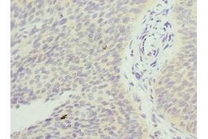Immunohistochemistry of paraffin-embedded human cervical cancer using ABIN7153251 at dilution of 1:100 (FXYD5 anticorps  (AA 22-145))