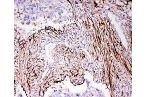 IHC-P: ADAM19 antibody testing of human lung cancer tissue