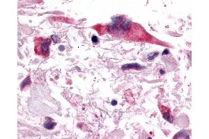 Anti-PGR1 / GPR153 antibody IHC of human Brain, Glioblastoma. (GPR153 anticorps  (C-Term))