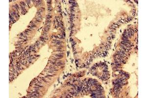 Immunohistochemistry analysis of human colon cancer using ABIN7168686 at dilution of 1:100 (SFRP4 anticorps  (AA 293-346))