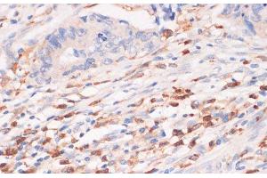 Immunohistochemistry of paraffin-embedded Human colon carcinoma using CYBA Polyclonal Antibody at dilution of 1:100 (40x lens). (CYBA anticorps)