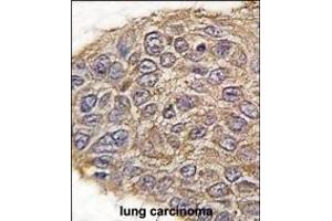 Formalin-fixed and paraffin-embedded human lung carcinoma tissue reacted with ALDOA antibody (N-term) (ABIN389191 and ABIN2839354) , which was peroxidase-conjugated to the secondary antibody, followed by DAB staining. (ALDOA anticorps  (N-Term))