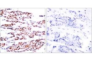 Immunohistochemistry analysis of paraffin-embedded human breast carcinoma, using JunB (Phospho-Ser79) Antibody.