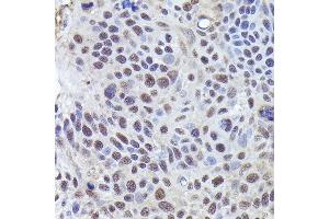 Immunohistochemistry of paraffin-embedded human esophageal cancer using CRCP Rabbit pAb (ABIN1679351, ABIN3019127, ABIN3019128 and ABIN6220728) at dilution of 1:200 (40x lens).