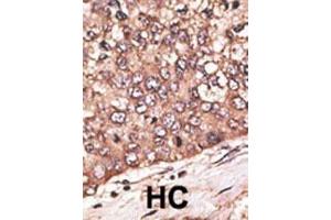 Formalin-fixed and paraffin-embedded human cancer tissue reacted with the primary antibody, which was peroxidase-conjugated to the secondary antibody, followed by DAB staining.