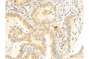 ABIN6266055 and ABIN6273350 at 1/100 staining Human lung cancer by IHC-P. (WWP1 anticorps  (Internal Region))