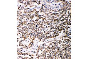 Anti-PMP70 antibody, IHC(P) IHC(P): Human Lung Cancer Tissue (CX3CL1 anticorps  (C-Term))