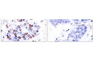Immunohistochemical analysis of paraffin-embedded human breast carcinoma tissue using NF-κB p65 (Ab-276) antibody (E021011). (NF-kB p65 anticorps)