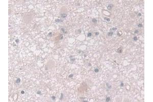 Detection of ADAMTS10 in Human Glioma Tissue using Polyclonal Antibody to A Disintegrin And Metalloproteinase With Thrombospondin 10 (ADAMTS10)