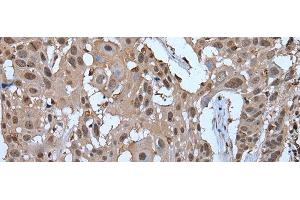 Immunohistochemistry of paraffin-embedded Human esophagus cancer tissue using ZNF787 Polyclonal Antibody at dilution of 1:45(x200) (ZNF787 anticorps)
