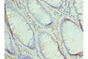 Immunohistochemistry of paraffin-embedded human colon cancer using ABIN7174493 at dilution of 1:100 (UBE2V2 anticorps  (AA 1-145))
