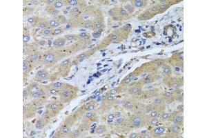 Immunohistochemistry of paraffin-embedded Human liver damage using UGT2B10 Polyclonal Antibody at dilution of 1:100 (40x lens). (UGT2B10 anticorps)