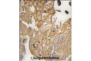 Formalin-fixed and paraffin-embedded human lung carcinoma tissue reacted with GMFG antibody (N-term) (ABIN392351 and ABIN2841990) , which was peroxidase-conjugated to the secondary antibody, followed by DAB staining. (GMFG anticorps  (N-Term))