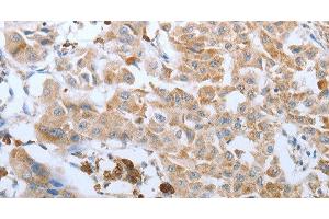 Immunohistochemistry of paraffin-embedded Human lung cancer tissue using FGF1 Polyclonal Antibody at dilution 1:50 (FGF1 anticorps)