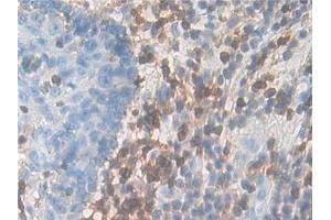 Detection of IL7R in Human Skin cancer Tissue using Polyclonal Antibody to Interleukin 7 Receptor (IL7R) (IL7R anticorps  (AA 173-260))