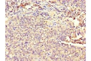 Immunohistochemistry of paraffin-embedded human cervical cancer using ABIN7163366 at dilution of 1:100 (ATP8A1 anticorps  (AA 448-545))