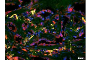 Formalin-fixed and paraffin-embedded lung carcinoma labeled with Anti-IDH2 Polyclonal Antibody, Unconjugated (ABIN751558) 1:200, overnight at 4°C, The secondary antibody was Goat Anti-Rabbit IgG, Cy3 conjugated used at 1:200 dilution for 40 minutes at 37°C.
