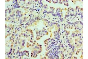 Immunohistochemistry of paraffin-embedded human lung cancer using ABIN7167634 at dilution of 1:100 (RMDN3 anticorps  (AA 1-470))