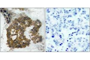Immunohistochemistry analysis of paraffin-embedded human lung carcinoma, using Akt2 (Phospho-Ser474) Antibody. (AKT2 anticorps  (pSer474))