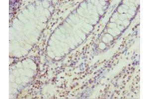 Immunohistochemistry of paraffin-embedded human colon cancer using ABIN7151256 at dilution of 1:100 (TRIM32 anticorps  (AA 1-280))