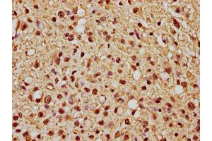 IHC image of nme1HU diluted at 1:10 and staining in paraffin-embedded human glioma cancer performed on a Leica BondTM system. (Histone H1.1 anticorps  (AA 18-30))